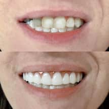 Alternate image Instant Smile Comfort Fit Flex Veneer Teeth Mold