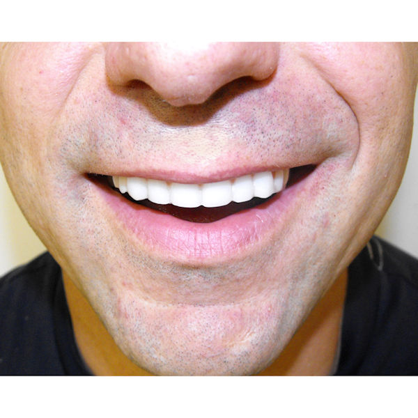 Product image for Instant Smile Comfort Fit Flex Veneer Teeth Mold