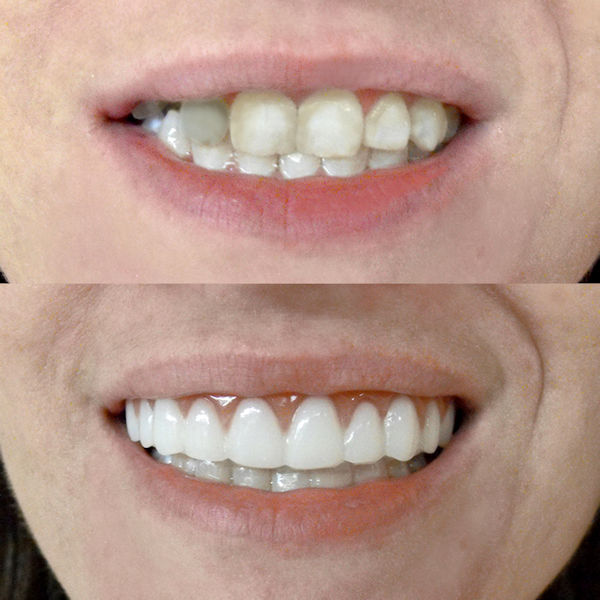 Product image for Instant Smile Comfort Fit Flex Veneer Teeth Mold