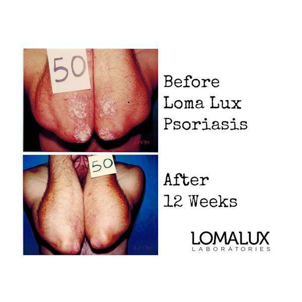 Product image for Lomalux Psoriasis Relief Liquid - 8 fl. oz.