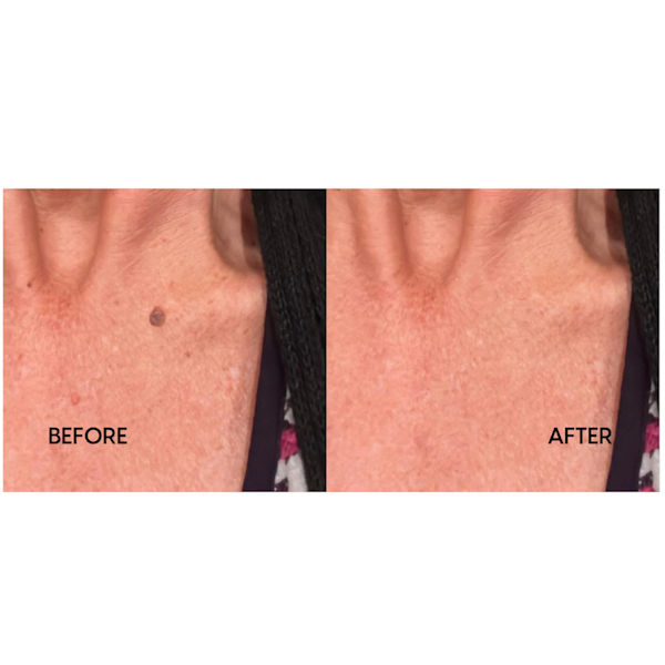 Skin Perfect Skin Tag, Mole, and Wart Remover Drops