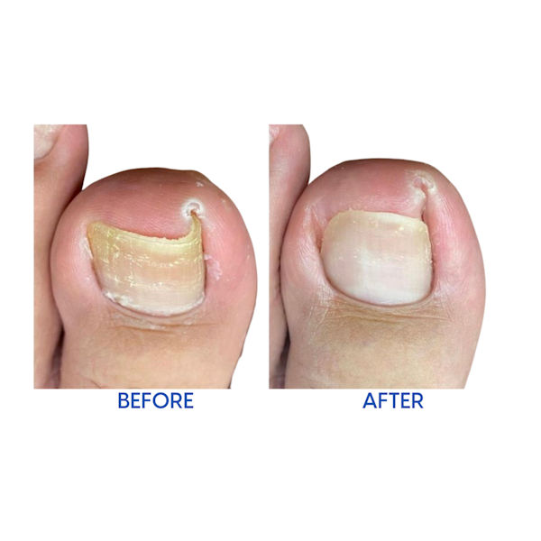 Product image for Relief Now Ingrown Toenail Pain Reliever