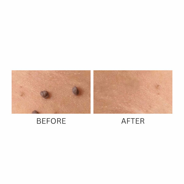 Product image for Skin Perfect Skin Tag and Wart Remover Formula