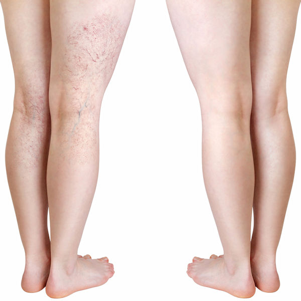 Product image for Thera Rx Varicose Veins Cooling Cream