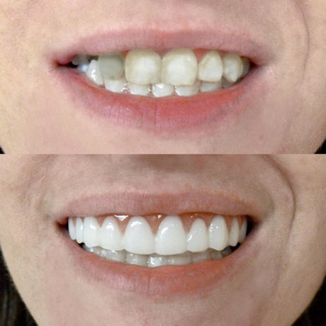 Instant Smile® Comfort Fit Flex Veneer Teeth Mold