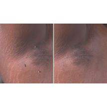 Alternate Image 9 for Hempvana® End Tag™ Skin Tag Remover Liquid Drops