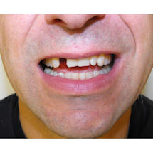 Alternate Image 4 for Instant Smile® Comfort Fit Flex Veneer Teeth Mold