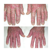 Alternate Image 2 for Eczema & Psoriasis Ointment