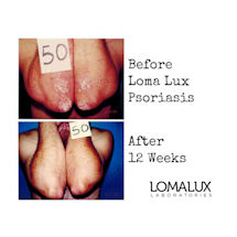 Alternate Image 2 for Lomalux Psoriasis Relief Liquid - 8 fl. oz.