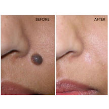 Alternate Image 1 for Skin Perfect Skin Tag, Mole, and Wart Remover Drops