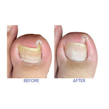 Alternate Image 1 for Relief Now Ingrown Toenail Pain Reliever