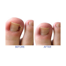 Alternate Image 2 for Relief Now Ingrown Toenail Pain Reliever