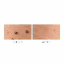 Alternate image for Skin Perfect Skin Tag and Wart Remover Formula
