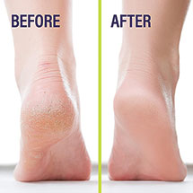 Alternate image for Foot Repair Liquid Adhesive